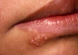 genital herpes and oral sex Genital herpes and oral sex